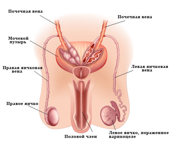 Варикоцеле - симптоми, причини розвитку, ступеня варикоцеле і методи лікування.