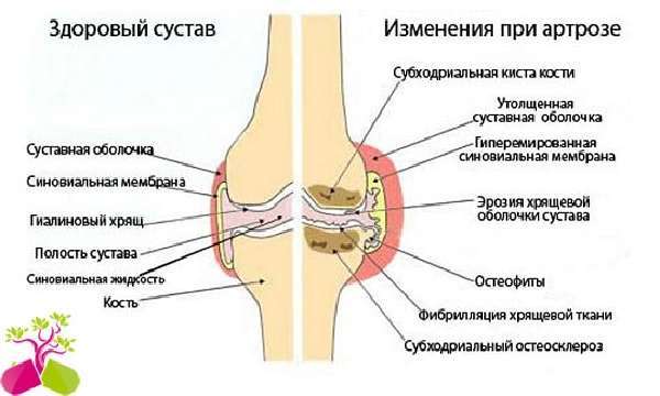Болить коліно при згинанні і розгинанні: причини, лікування, можливі хвороби