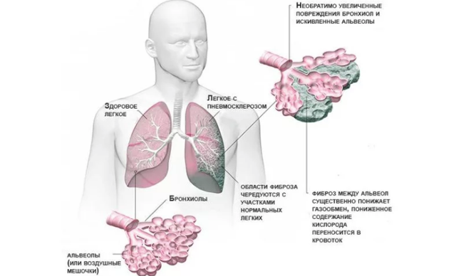 Наслідки і ускладнення пневмофиброза легких