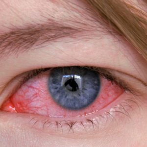 Алергічний кератит - симптоми, лікування у дитини і у дорослого