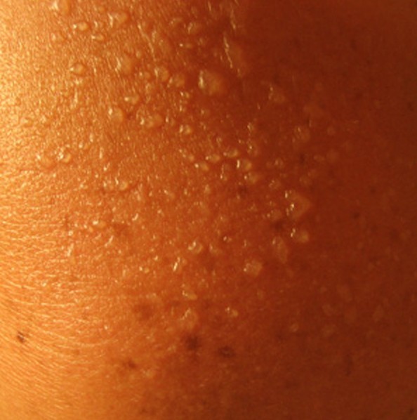 Фотодерматит: симптоми, лікування алергії на сонце