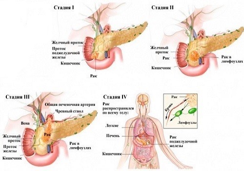 Рак підшлункової залози: симптоми, лікування, стадії раку підшлункової залози, прогнози, скільки живуть з раком підшлункової
