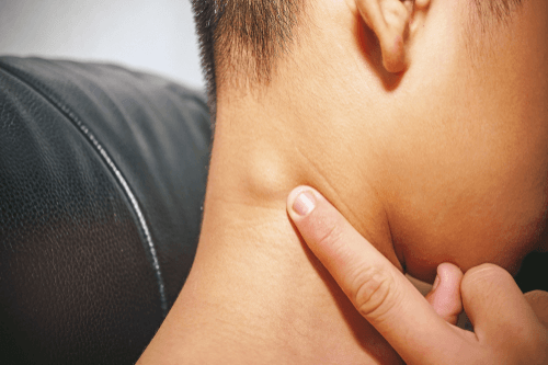 Рак лімфовузлів на шиї: симптоми і ознаки онкології