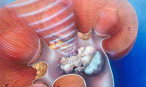 Чим небезпечні мікроліти в нирках: можливі ускладнення при каменях у нирках і методи лікування  