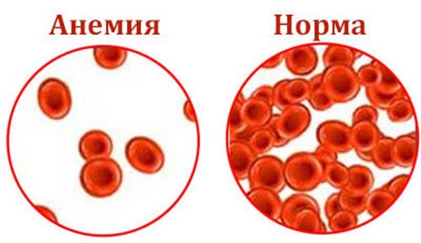 Гемолітична анемія з аналізу крові: причини захворювання, супутні симптоми, варіанти терапії