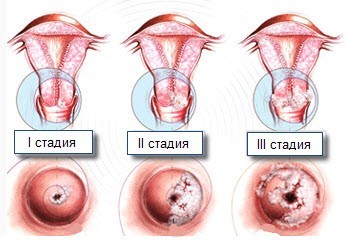 Дисплазія шийки матки: причини, симптоми, стадії, діагностика, лікування, профілактика. 