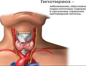 Гіпотиреоз: симптоми захворювання щитовидної залози, причини, діагностика, лікування
