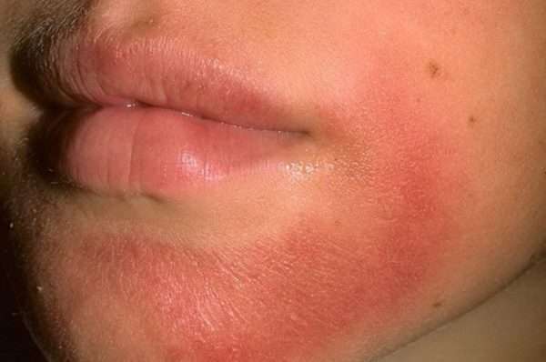 Антиалергійна мазь від алергії на шкірі і руках у дорослих
