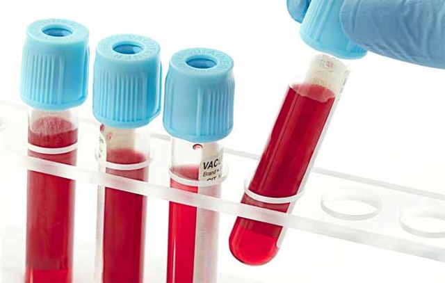 Знижені лейкоцити в крові: основні причини зниження у дорослого