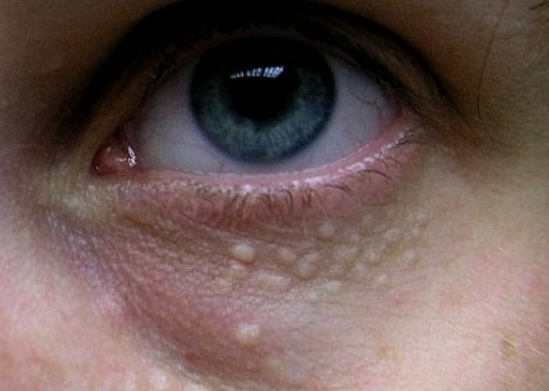 Жировики на очах або століттях: як позбутися, причини появи, лікування, способи видалення
