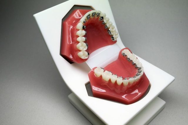 Зубна пластинка для дітей або брекети - що краще, показання до установки