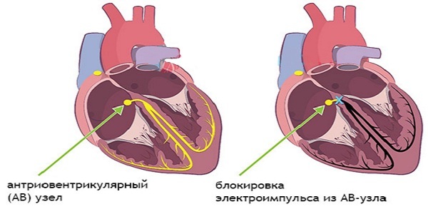 Серцевий м'яз людини: властивості, чому болить м'язова тканина, її спазм