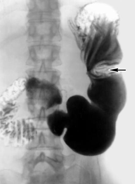 Виразка шлунка: що це, код за МКБ10, симптоми, види, діагностика і лікування