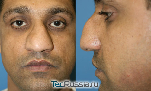 Великий ніс - пластика носа, операція, ускладнення після ринопластики, підготовка