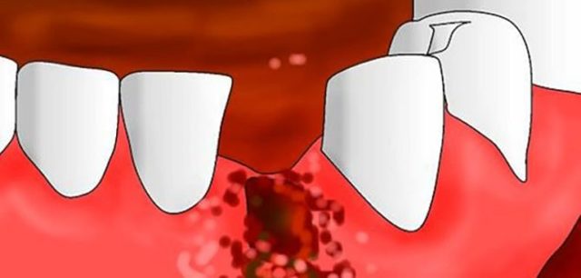 Альвеолит після видалення зуба: симптоми, фото і лікування