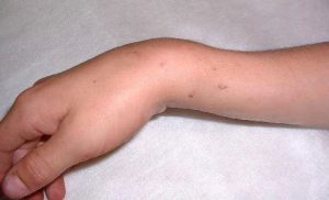 Помилковий суглоб після перелому: лікування, операція, причини формування помилкового суглоба