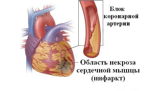 Інфаркт на ногах: симптоми, причини і наслідки інфаркту, перенесеного на ногах