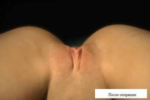 Жіночі статеві губи: анатомія, схеми і будова