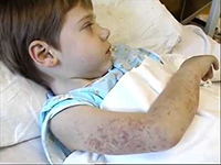 Алергічний васкуліт - що це за хвороба, симптоми, лікування у дітей та дорослих