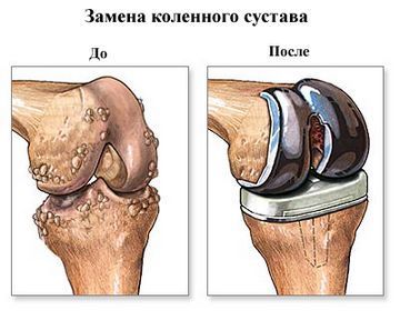 Посттравматичний артроз колінного суглоба: ступеня, симптоми, лікування