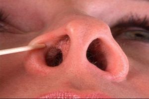 Синехії носа: причини, діагностика та методи лікування  
