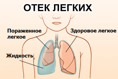 Інфаркт на ногах: симптоми, причини і наслідки інфаркту, перенесеного на ногах