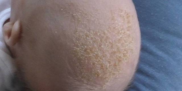 Себорейний дерматит у немовляти: як прибрати скоринки на голові у дитини