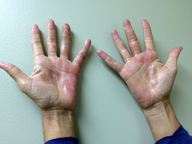 Актініческій дерматит на руках, на обличчі: що це таке, лікування