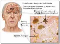 Хвороба Альцгеймера: причини виникнення, діагностування та лікування, прогноз для життя