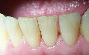 Тріщини на зубах: що це, що робити, як лікувати тріщина на емалі