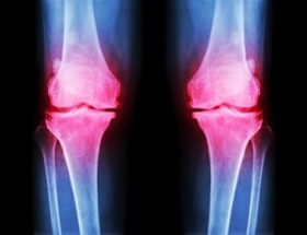 Еностоз стегнової кістки: опис патології і сучасні способи терапії захворювання