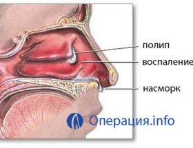 Видалення поліпів у носі: ендоскопічна і лазерна операції