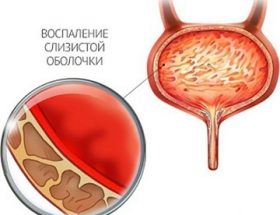 Цервіцит шийки матки: причини захворювання, його симптоми, методи лікування