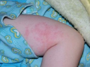Суха і шорстка шкіра у дитини: чому лущиться шкіра, лікування сухої шкіри у дітей