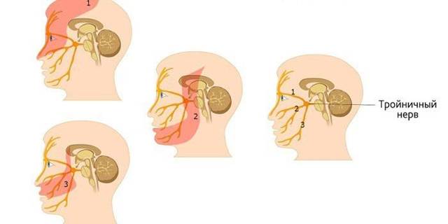 Невралгія трійчастого нерва особи: симптоми, лікування, причини