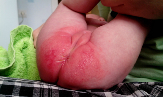 Креми і мазі під підгузник дитині, кошти для лікування пелюшкового дерматиту