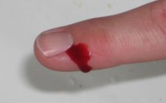 Чим обробити фалангу пальця, якщо відірвало шматок шкіри?