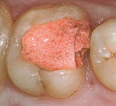 Які пломби краще ставити на жувальні і передні зуби: порівняння пластмасових і светоотверждаємих пдломб