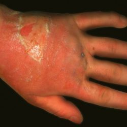 Алергічний дерматит: симптоми і лікування алергічного дерматиту у дітей і дорослих