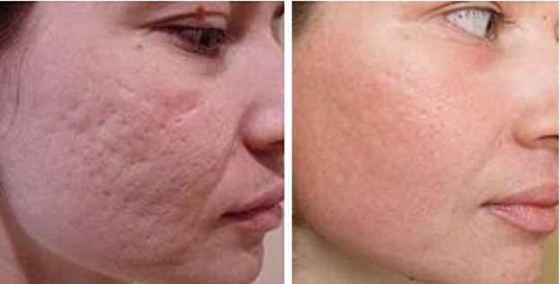 Лазерна шліфовка рубців на обличчі й тілі: протипоказання, фото до і після