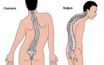 Кіфоз у дітей: симптоми, лікування, діагностика, причини і профілактика