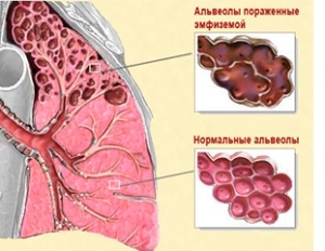 Альвеолит легких: симптоми, лікування в домашніх умовах, діагностика, прогноз