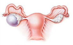 Кистома яєчника: правого, лівого, що це таке, як лікувати, операція при великій кістоми