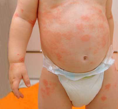 Як лікувати атопічний дерматит у дитини 2, 8 років