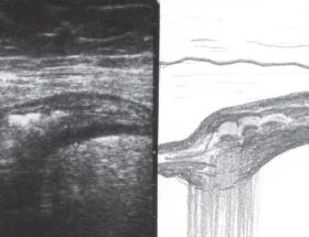 Дивертикулез кишечника: іригоскопія і МРТ для визначення захворювання