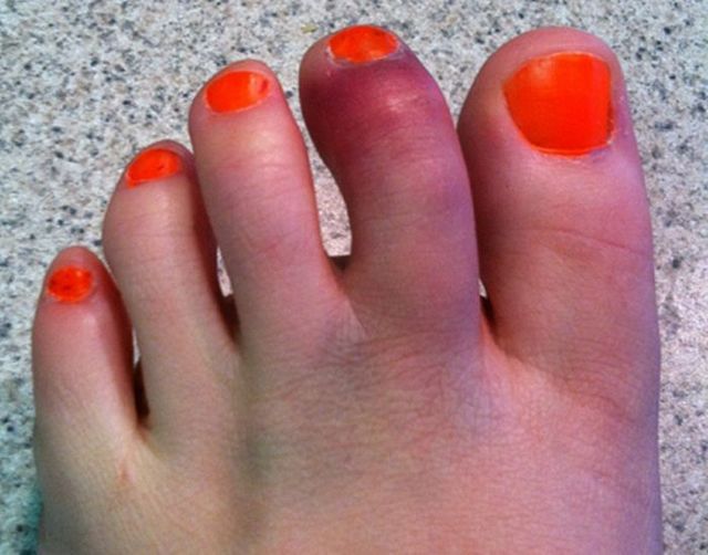 Перелом пальця на нозі: причини, діагностика, перша допомога, лікування