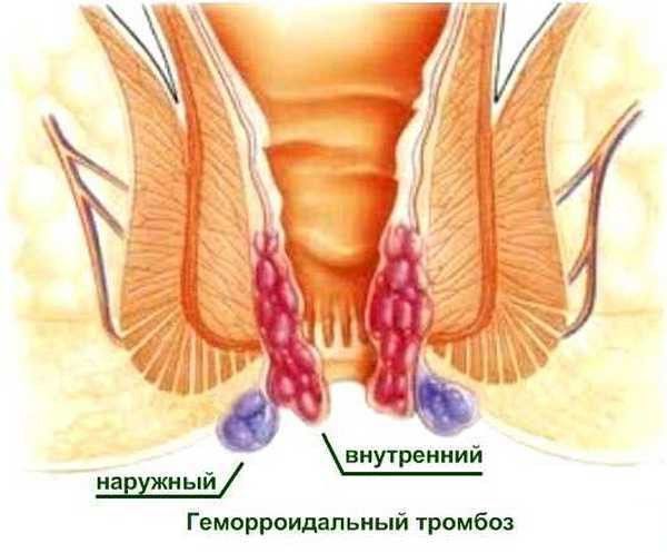 Тромбоз гемороїдального вузла: симптоми і лікування (медикаменти, хірургія)
