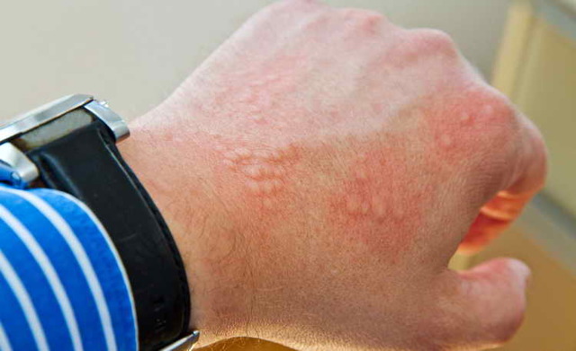 Холодова алергія - симптоми і лікування народними засобами