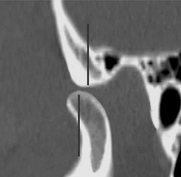 Як розшифрувати МРТ скронево-нижньощелепного суглоба? | ОкейДок