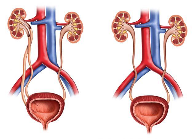 Ектопія гирла сечоводу: що це, діагностика, симптоми і лікування